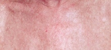 Florida, After IPL Rejuvenation®
