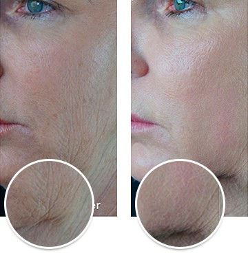 Laser Skin Resurfacing before and after in Miami, FL Laser Skin Resurfacing, before and after, Miami