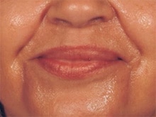 radiesse-injections-01-bef