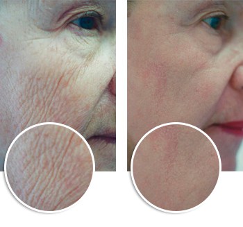 Skin Resurfacing before and after in Miami, FL Skin Resurfacing, before and after, Miami