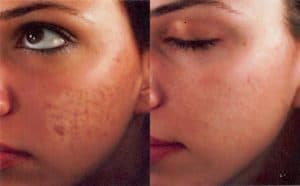 Acne Treatment in Miami Acne Treatment Miami