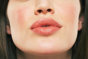 Facial redness, FL Facial redness, FL