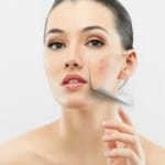 Ematrix for Acne Scar Treatment