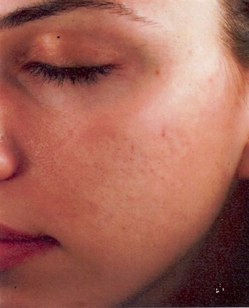 eMatrix™ Patient After