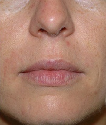 After Restylane Injections