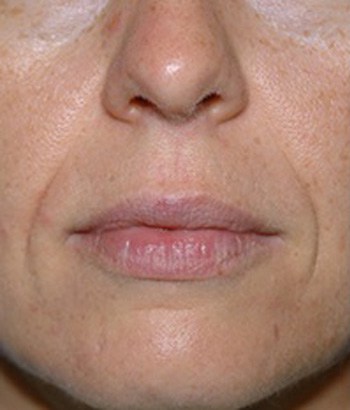 Before Restylane Injections