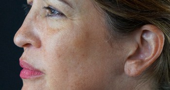 Before IPL Rejuvenation®, FL Before IPL Rejuvenation®, FL