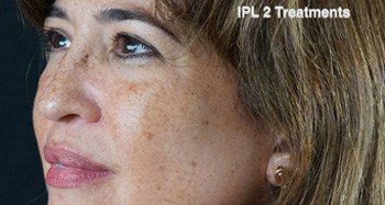 After IPL Rejuvenation®, FL After IPL Rejuvenation®, FL