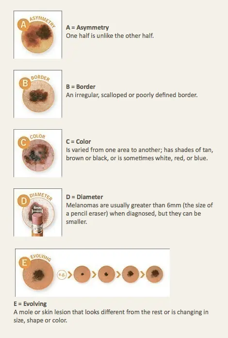The ABCDE of Melanoma