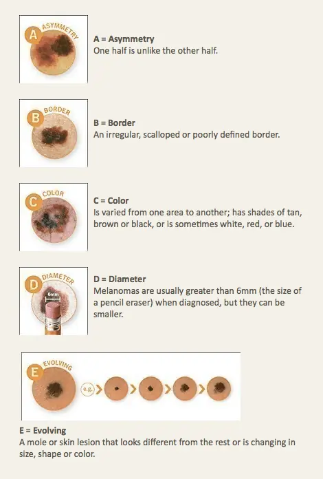 Skin Cancer Treatment Miami FL Skin Cancer Treatment