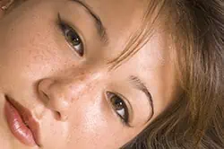 Hyperpigmentation or Hypopigmentation