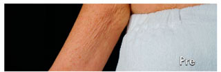 Patient 2 - Frontal Before Patient 2 - Frontal Before