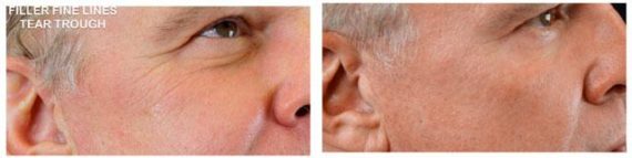 Injectable Facial Fillers before and after photos in Bay Harbor Islands, FL