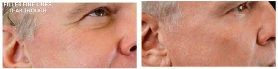 Injectable Facial Fillers before and after photos in Bay Harbor Islands, FL