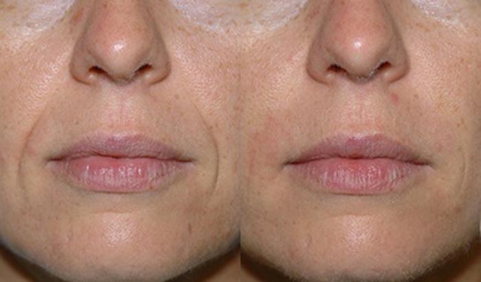 Injectable Facial Fillers before and after photos in Bay Harbor Islands, FL, Patient 4303