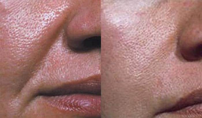 Patient 4306, Injectable Facial Fillers before and after photos Injectable Facial Fillers before and after photos in Bay Harbor Islands, FL, Patient 4306
