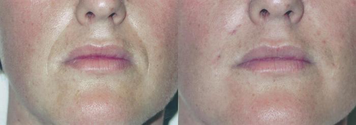 Injectable Facial Fillers before and after photos in Bay Harbor Islands, FL, Patient 4309
