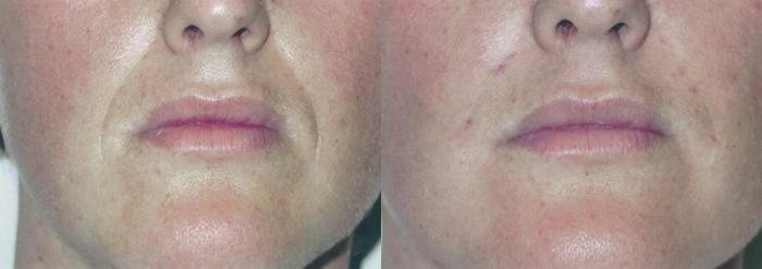 Patient 4309, Injectable Facial Fillers before and after photos Injectable Facial Fillers before and after photos in Bay Harbor Islands, FL, Patient 4309