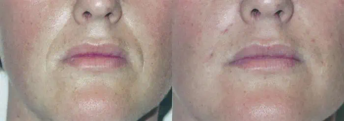 Injectable Facial Fillers before and after photos in Bay Harbor Islands, FL, Patient 4309