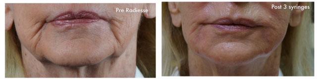 Patient 4313, Injectable Facial Fillers before and after photos Injectable Facial Fillers before and after photos in Bay Harbor Islands, FL, Patient 4313