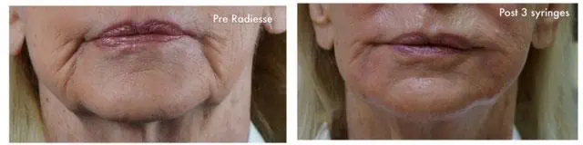 Injectable Facial Fillers before and after photos in Bay Harbor Islands, FL, Patient 4313