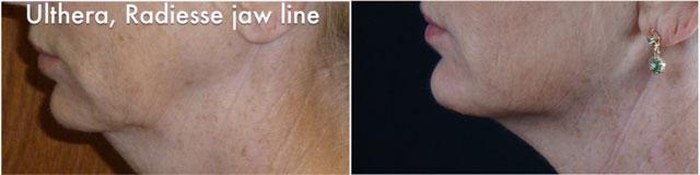  before and after photos in Bay Harbor Islands, FL, Soft Tissue Fillers in Miami, FL