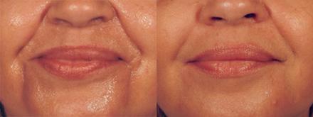 Patient 4321, Injectable Facial Fillers before and after photos Injectable Facial Fillers before and after photos in Bay Harbor Islands, FL, Patient 4321