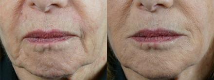 Patient 4324, Injectable Facial Fillers before and after photos Injectable Facial Fillers before and after photos in Bay Harbor Islands, FL, Patient 4324