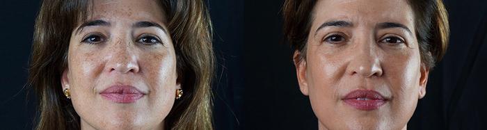 Patient 4327, Intense Pulsed Light Rejuvenation (IPL) before and after photos Intense Pulsed Light Rejuvenation (IPL) before and after photos in Bay Harbor Islands, FL, Patient 4327