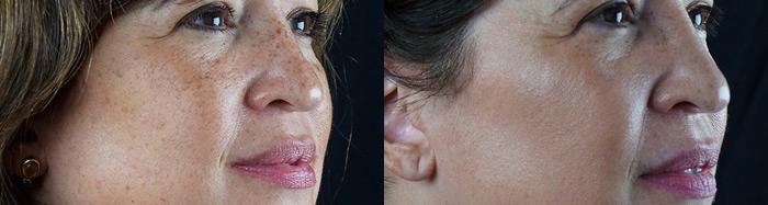 Patient 4327, Intense Pulsed Light Rejuvenation (IPL) before and after photos Intense Pulsed Light Rejuvenation (IPL) before and after photos in Bay Harbor Islands, FL, Patient 4327