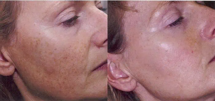 Patient 4333, Intense Pulsed Light Rejuvenation (IPL) before and after photos Intense Pulsed Light Rejuvenation (IPL) before and after photos in Bay Harbor Islands, FL, Patient 4333