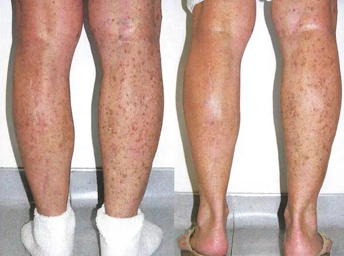 Patient 4337, Intense Pulsed Light Rejuvenation (IPL) before and after photos Intense Pulsed Light Rejuvenation (IPL) before and after photos in Bay Harbor Islands, FL, Patient 4337