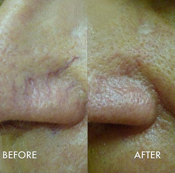 Laser Blood Vessel Removal before and after photos in Bay Harbor Islands, FL