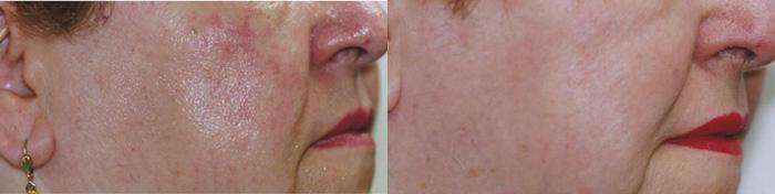 Patient 4345, Laser Blood Vessel Removal before and after photos Laser Blood Vessel Removal before and after photos in Bay Harbor Islands, FL, Patient 4345