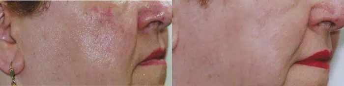 Laser Blood Vessel Removal before and after photos in Bay Harbor Islands, FL, Patient 4345
