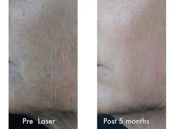 Laser Resurfacing before and after photos in Bay Harbor Islands, FL