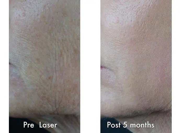 Laser Resurfacing before and after photos in Bay Harbor Islands, FL, Patient 4348