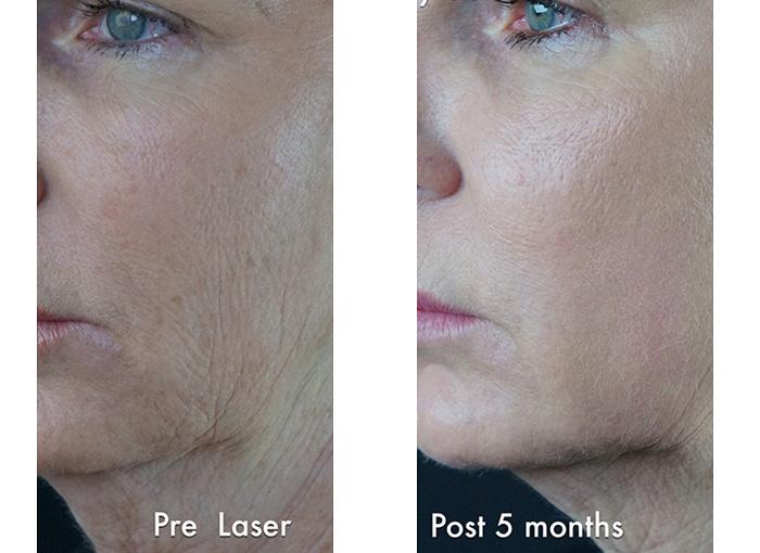 Patient 4348, Laser Resurfacing before and after photos Laser Resurfacing before and after photos in Bay Harbor Islands, FL, Patient 4348