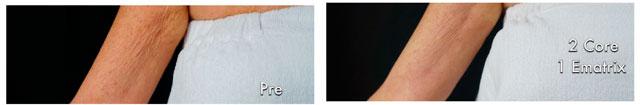 Patient 4354, Laser Resurfacing before and after photos Laser Resurfacing before and after photos in Bay Harbor Islands, FL, Patient 4354