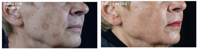  before and after photos in Bay Harbor Islands, FL, Scar Resurfacing Treatment in Miami, FL