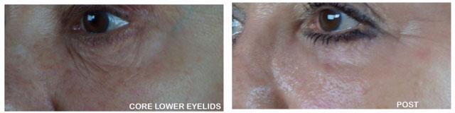 Laser Resurfacing before and after photos in Bay Harbor Islands, FL, Patient 4364