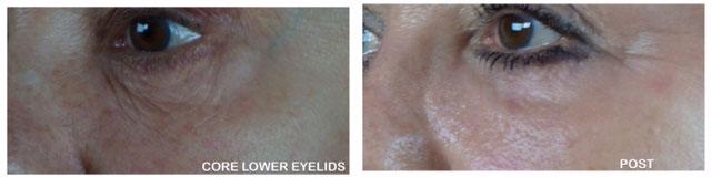 Patient 4364, Laser Resurfacing before and after photos Laser Resurfacing before and after photos in Bay Harbor Islands, FL, Patient 4364