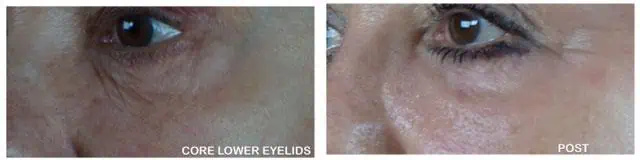 Patient 4364, Laser Resurfacing before and after photos Laser Resurfacing before and after photos in Bay Harbor Islands, FL, Patient 4364