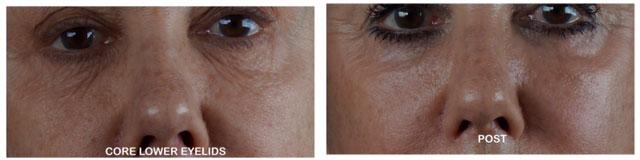 Patient 4368, Laser Resurfacing before and after photos Laser Resurfacing before and after photos in Bay Harbor Islands, FL, Patient 4368