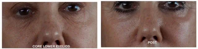 Laser Resurfacing before and after photos in Bay Harbor Islands, FL, Patient 4368