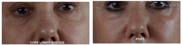 Patient 4368, Laser Resurfacing before and after photos Laser Resurfacing before and after photos in Bay Harbor Islands, FL, Patient 4368