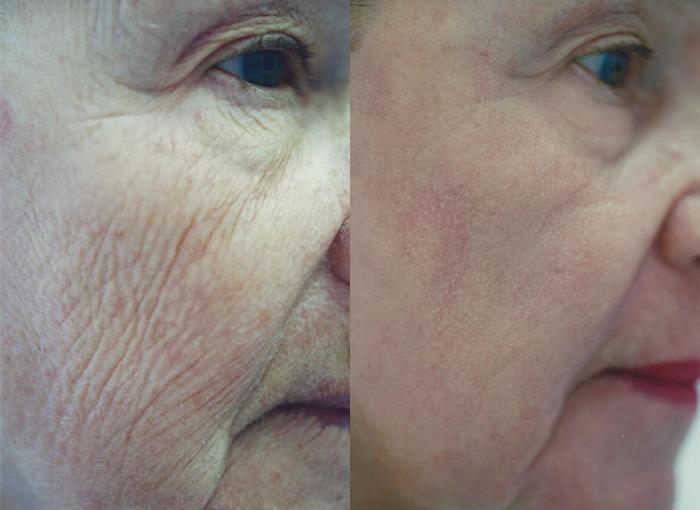 Laser Resurfacing before and after photos in Bay Harbor Islands, FL, Patient 4371