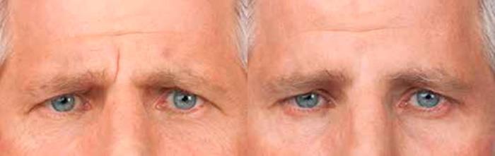 Neurotoxin before and after photos in Bay Harbor Islands, FL, Patient 4377