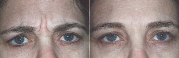 Neurotoxin before and after photos in Bay Harbor Islands, FL