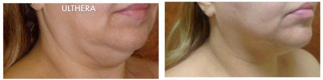 Patient 4388, Ulthera before and after photos Ulthera before and after photos in Bay Harbor Islands, FL, Patient 4388